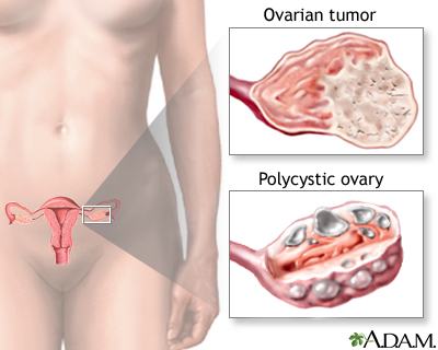 Overproductive ovaries Overproductive ovaries