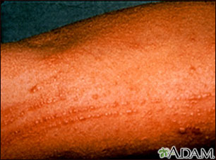 Erupción por roble venenoso en el brazo Erupción por roble venenoso en el brazo