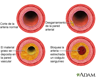 Proceso de evolución de la aterosclerosis Proceso de evolución de la aterosclerosis