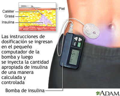 Bomba de insulina Bomba de insulina