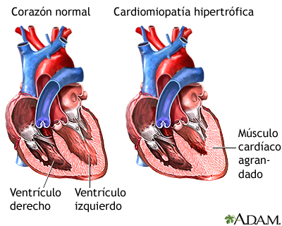 Cardiomiopatía hipertrófica Cardiomiopatía hipertrófica