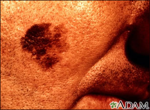 Cáncer de piel, primer plano del melanoma léntigo maligno Cáncer de piel, primer plano del melanoma léntigo maligno