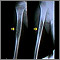 Ewing sarcoma - X-ray