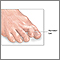 Hammer toe