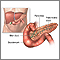 Pancreatitis - serie