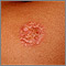 Necrobiosis lipoídica diabética - abdomen
