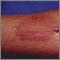 Dermatitis - contacto