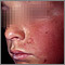 Dermatitis - contacto en la mejilla