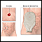 Ileostomía - estoma y bolsa
